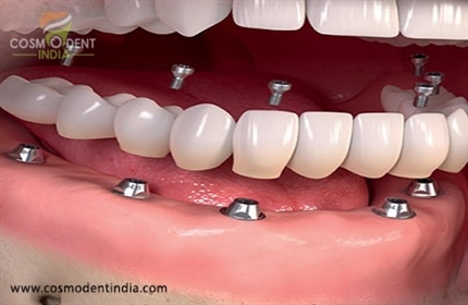 how-much-does-it-cost-for-full-dental-implants