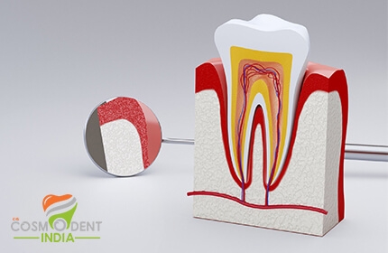 root-canal-treatment-cost-in-delhi