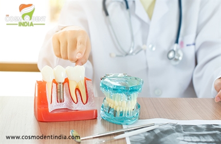 आपको 4-दंत-प्रत्यारोपणों के बारे में सब कुछ जानने की आवश्यकता है