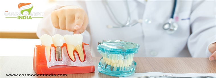 आपको 4-दंत-प्रत्यारोपणों के बारे में सब कुछ जानने की आवश्यकता है