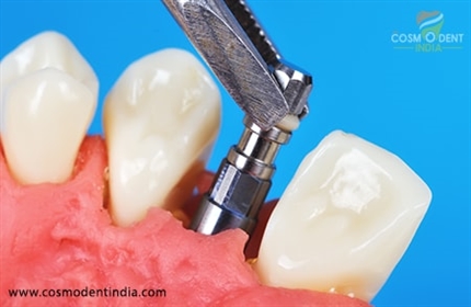 Beneficios de los implantes dentales inmediatos.