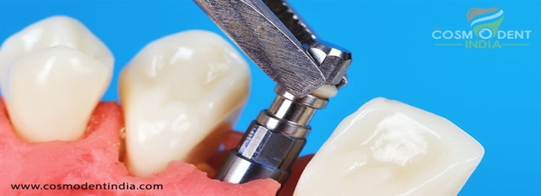तत्काल-दंत-प्रत्यारोपण के लाभ