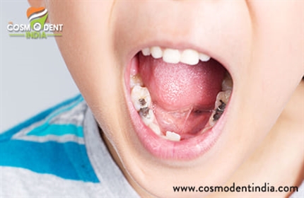 子供の歯の空洞