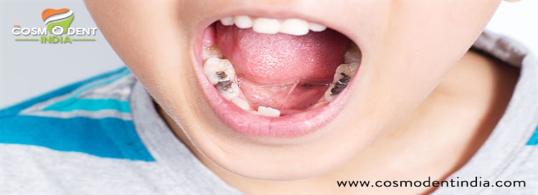 children-teeth-cavity