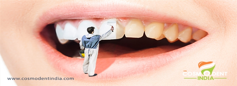 कॉस्मेटिक-दंत-उपचार-के-अलग-अलग प्रकार क्या हैं