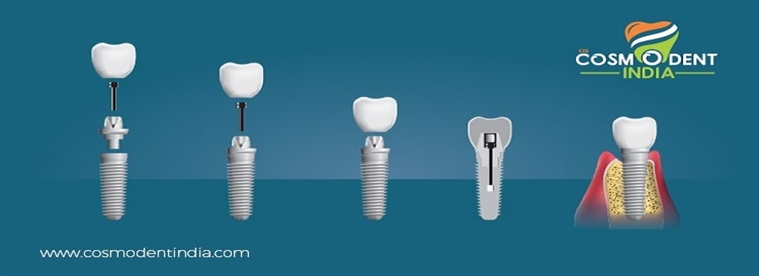 दंत-प्रत्यारोपण-तैयारी-चरण-परिणाम