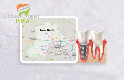 افضل مركز علاج زرع الاسنان في دلهي