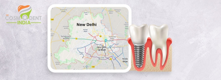 दिल्ली में सर्वश्रेष्ठ-दंत-प्रत्यारोपण-उपचार-केंद्र