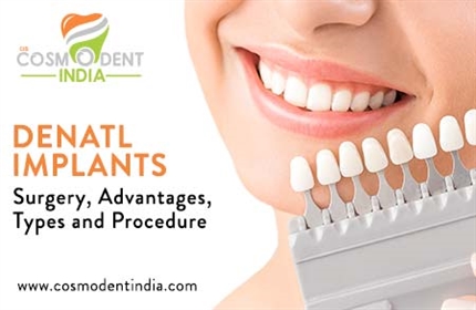 歯科インプラント-手術-利点-タイプと手順