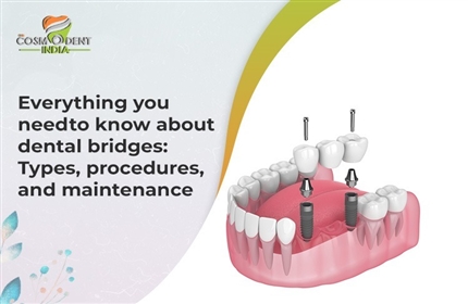 歯科用ブリッジについて知っておくべきことすべて