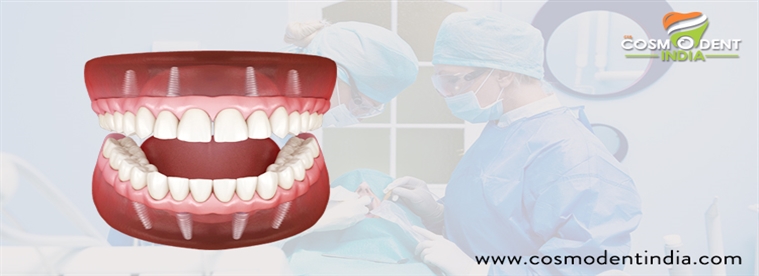 كامل الأسنان زرع استبدال