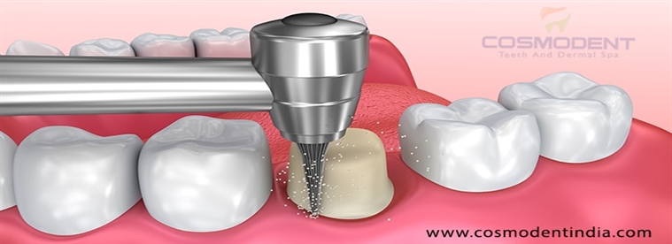 Obtén el mejor médico en implantes dentales en la India por el mejor médico