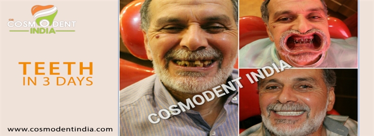 immediate-teeth-implant