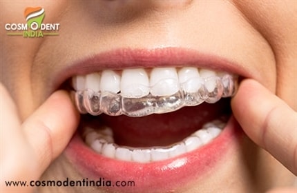 علاج تقويم الأسنان في الهند