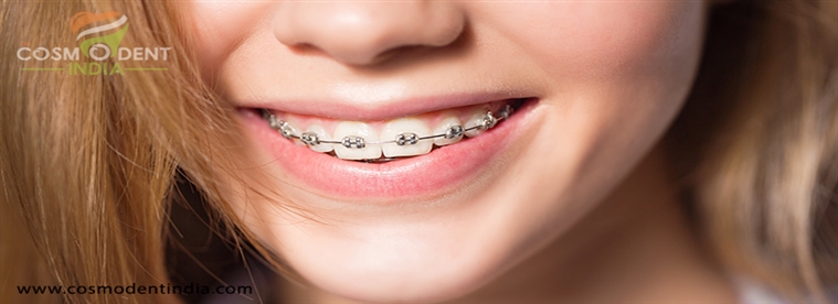 invisalign-teeth-braces