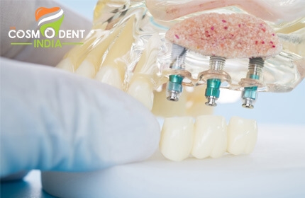 दंत-प्रत्यारोपण के बारे में जानें
