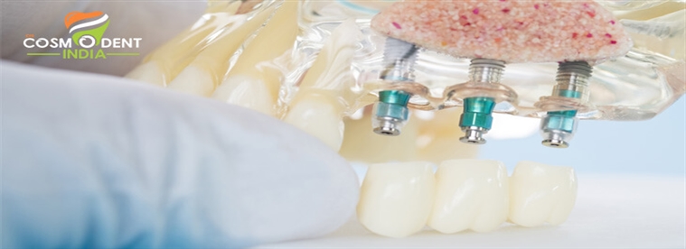 saber-sobre-implantes-dentales