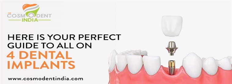 perfect-guide-to-all-on-4-dental-implants