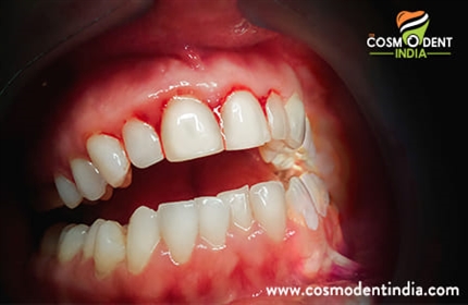 periodontitis-उपचार