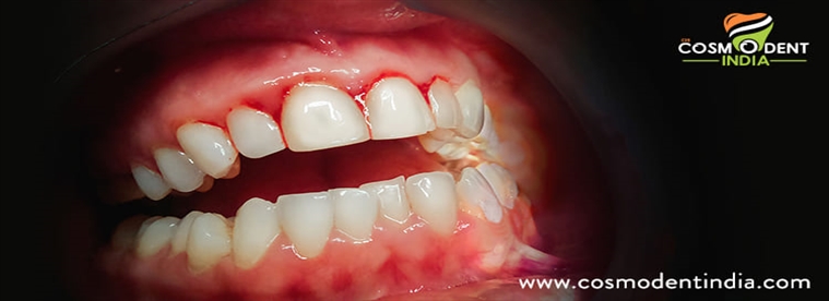 periodontitis-उपचार