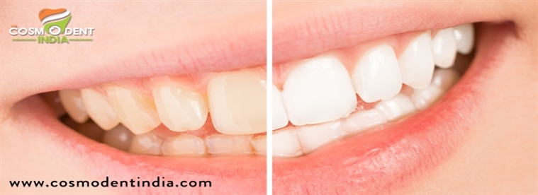relight-your-spark-with-teeth-whitening