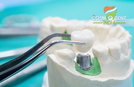 tooth-implants-are-now-simpler-and-affordable