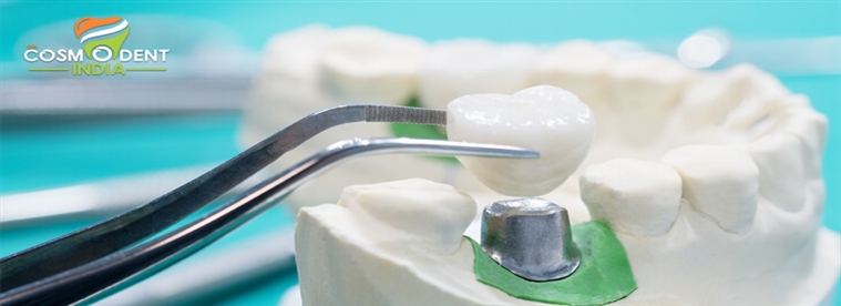 दांत-प्रत्यारोपण-अब-सरल-और-किफायती हैं