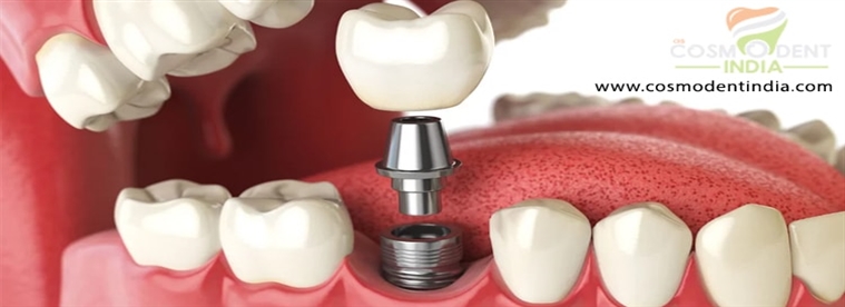 using-implants-to-stabilize-dentures