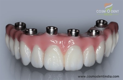 What-is-a-dental-implant-bridge