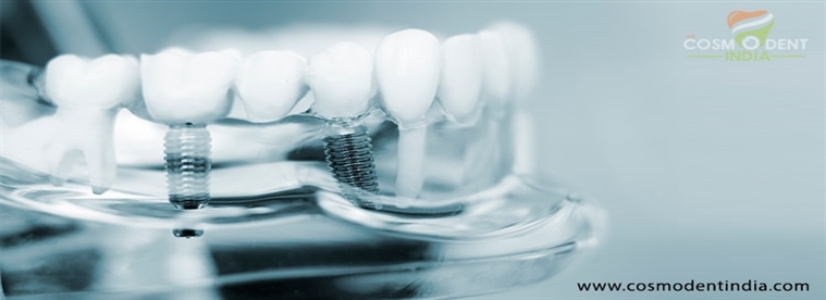 क्या करने के लिए विचार करना पहले जा रहा के लिए सब-ऑन-4-दंत-प्रत्यारोपण