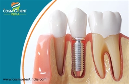 zygoma-implants-teeth-replacement-despite-poor-bone-quality