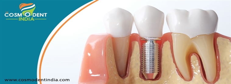 zygoma-प्रत्यारोपण-दांत बदलने की-के बावजूद गरीब की हड्डी गुणवत्ता