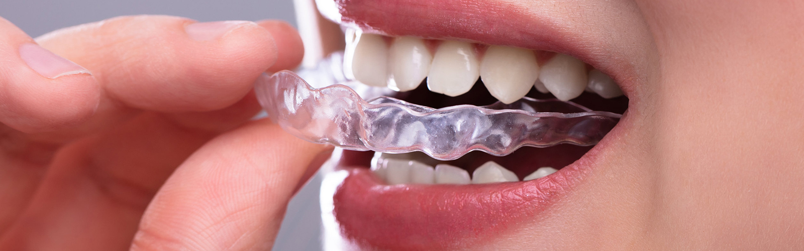 everything-you-need-to-know-about-invisible-braces