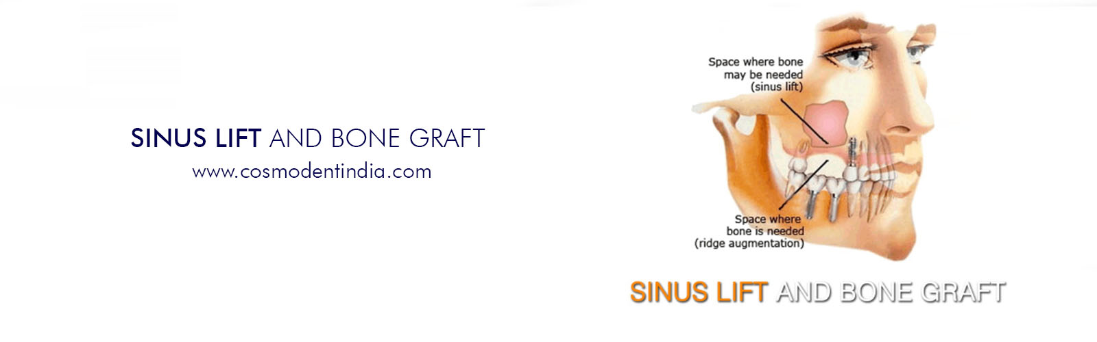 enxertos sinus-lift-and-bone