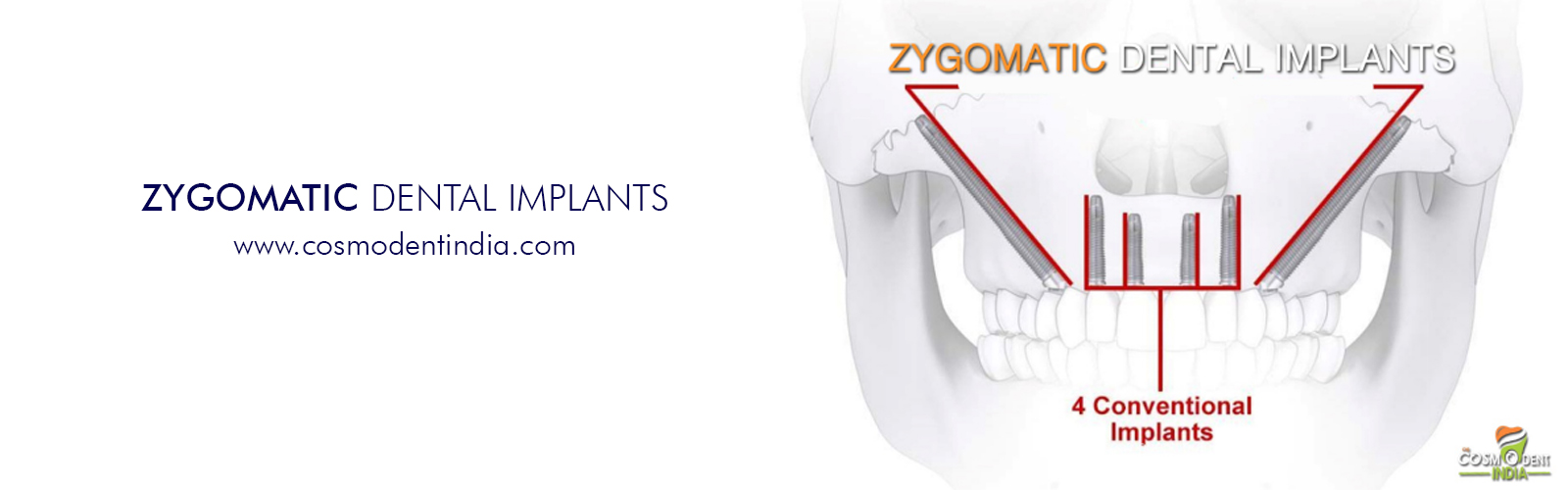 zygomatic-implants-in-india