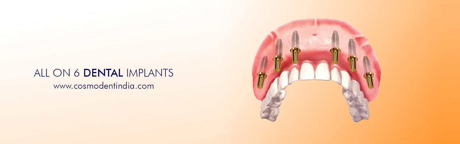 all-on-6-dental-implants-india
