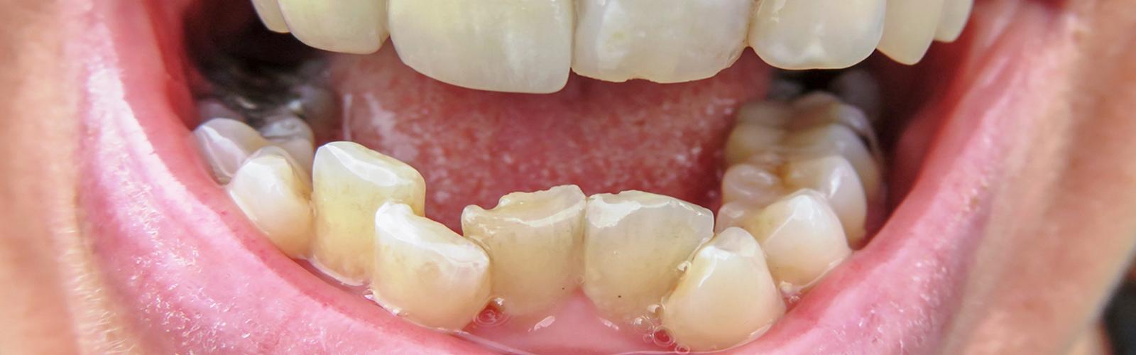 how-to-fix-crooked-teeth