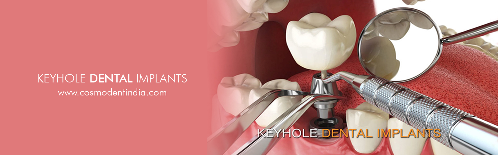 buraco da fechadura-implantes dentários