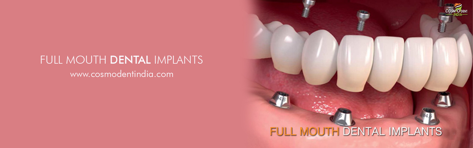 implantes dentales de boca completa en la India