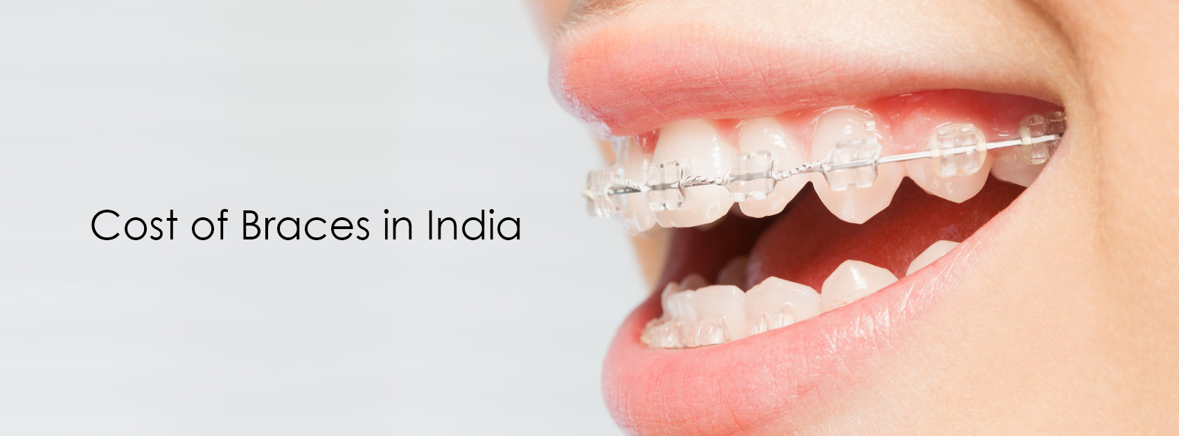 Decoding the Dental Braces Cost in Noida