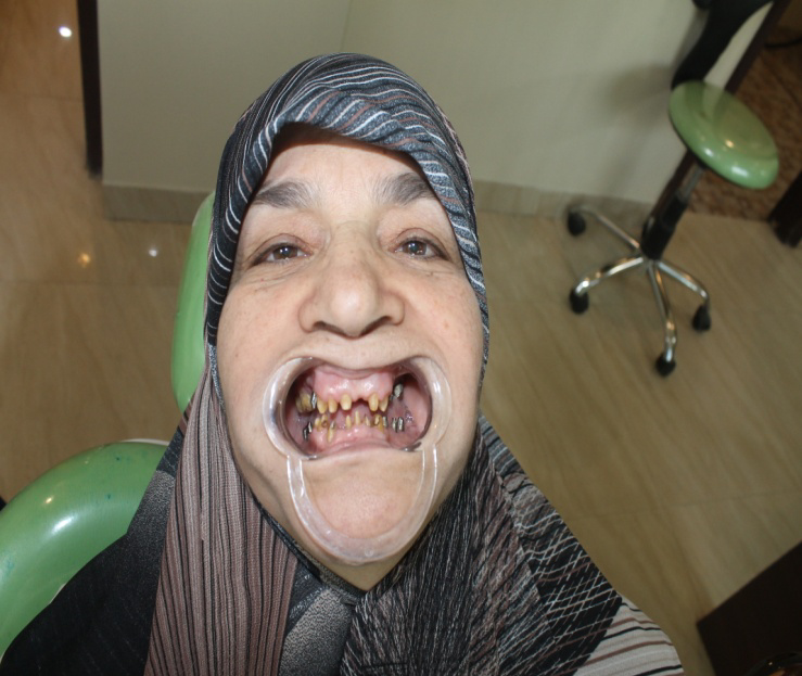 उपचार के दौरान- दंत चिकित्सा देखभाल