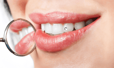 dental-braces-in-india